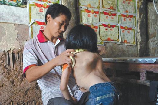 有嚴(yán)重脊椎畸形及胸腔隆突病的李文霞。