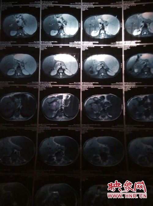 寧陵少年患病十幾年仍堅(jiān)持上學(xué) 無錢治病盼救助 寧陵少年患病十幾年仍堅(jiān)持上學(xué) 無錢治病盼救助