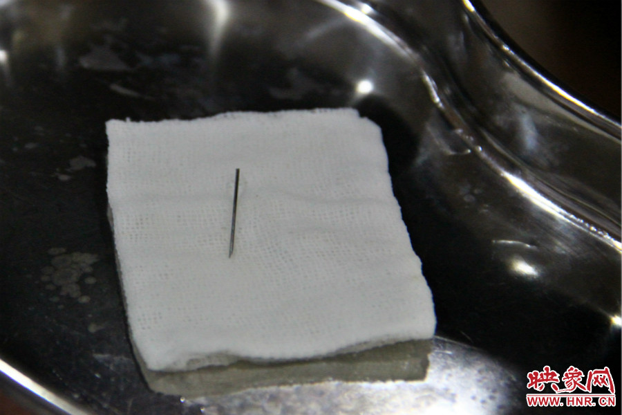 上午11點(diǎn)30分許，小龍腦中鋼針已經(jīng)成功取出。