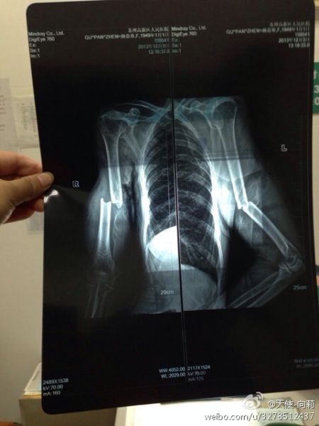 圖為微博上傳“范某某的妻子顧盤珍手被打斷?！? width=