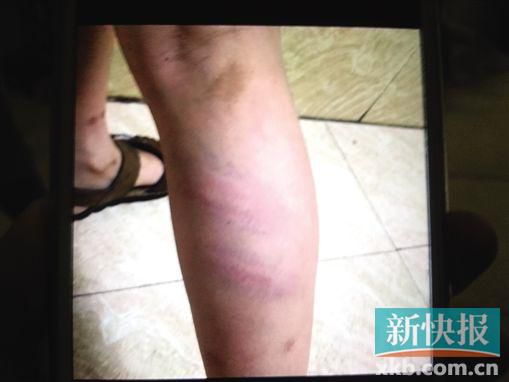 小宇腿部有明顯瘀痕。 翻拍自家屬手機(jī)