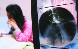 假牙上的鋼絲刺破食管，而薄薄的食道壁緊貼主動脈血管，極易造成血管破裂