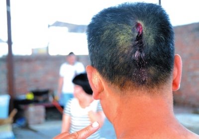 崔先生頭部受傷。京華時報記者趙思衡攝/視頻