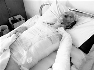 周小姐的頭、頸、軀干、四肢均被燒傷，其中面部燒傷最為嚴(yán)重。