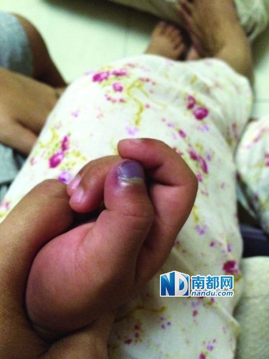 小逸手指被夾傷。