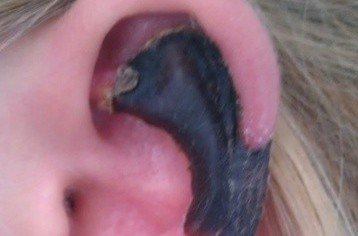 荷蘭女子旅游途中被蜘蛛咬，耳軟骨溶解變黑。