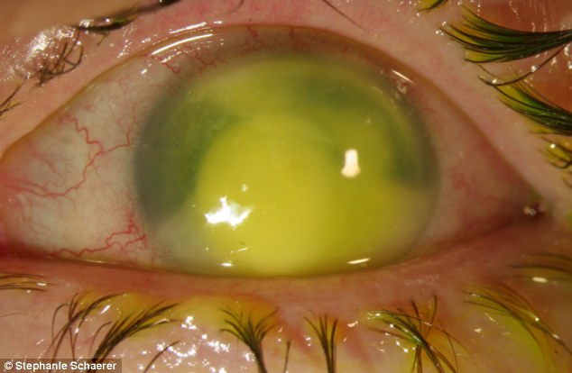 恐怖慎入！隱形眼鏡致英女子摘除眼球