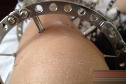 矯正"O型腿"手術全過程