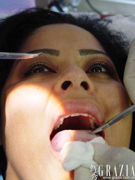 舌頭縫塑料片減肥 舌頭縫塑料片減肥