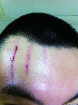 　2013年，被打者受傷照