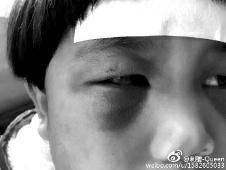 6月2日，網(wǎng)曝渭南市臨渭區(qū)一不滿5歲的女童遭奶奶毆打，眼圈青腫，引起網(wǎng)友關(guān)注，但孩子父母和爺爺均稱是摔倒導(dǎo)致。相關(guān)部門介入調(diào)查發(fā)現(xiàn)確為奶奶毆打所致，鑒于其身體原因已進(jìn)行批評教育。