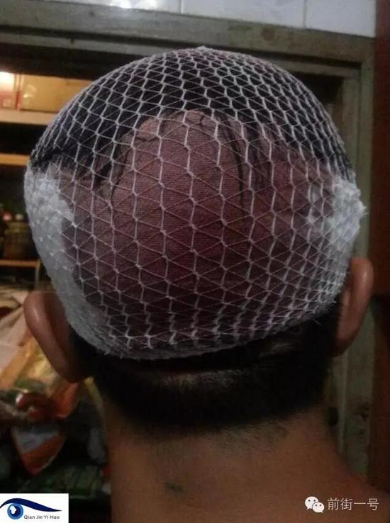 李律師受傷后縫合三針。