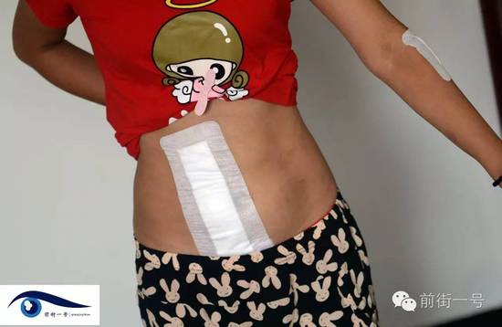 小金腹部的傷口。