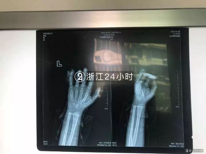 嚇哭！6歲男孩被夾斷手指 罪魁禍?zhǔn)拙故切７? oldsrc=