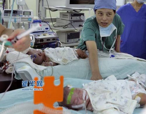 一對(duì)連體女嬰成功分離