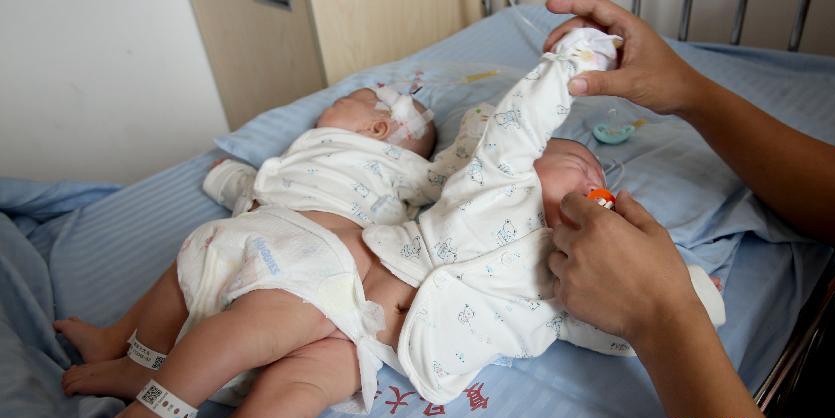 一對(duì)連體女嬰成功分離