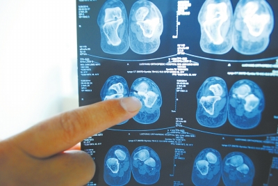 X光片顯示,確實(shí)有一根殘留的螺絲釘。