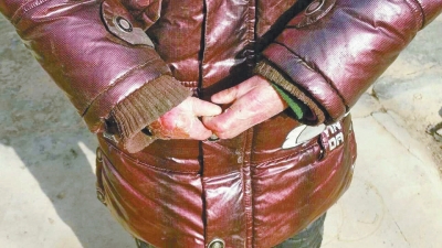 長(zhǎng)期受損的手指，已經(jīng)長(zhǎng)在了一起。