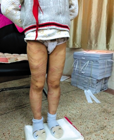 4月3日晚，微博網(wǎng)友“@朝廷半日閑”發(fā)圖文微博展示男童被虐待的慘狀。 微博截圖