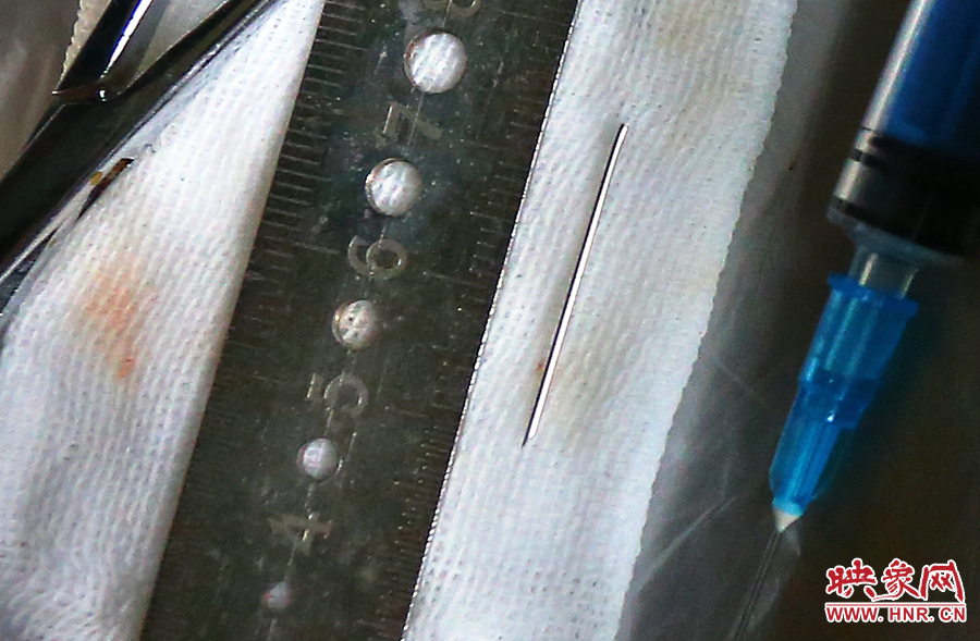 上午11點42分，大龍顱內(nèi)的鋼針被取出