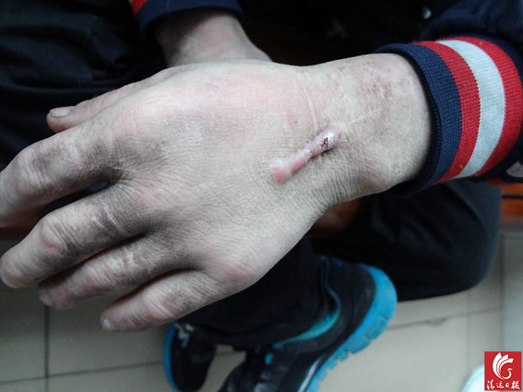 被發(fā)現(xiàn)男子手上的傷疤。
