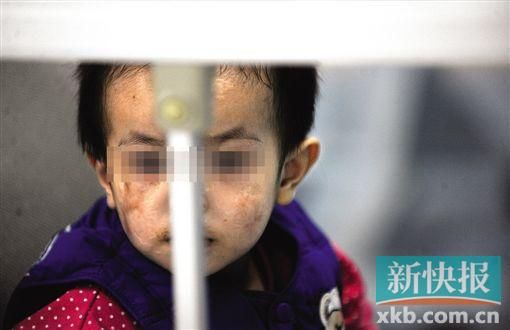 去年3月就能出院的小華(化名),目前還在廣州市婦兒醫(yī)療中心的PICU里住著。新快報記者 孫毅/攝