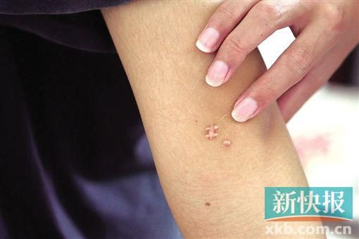 取出針后李星兒手臂留下了傷口。新快報記者 張國鋒/攝