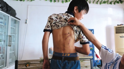 　昨日，奶西村，被打的小剛后背上條條瘀痕依然明顯。