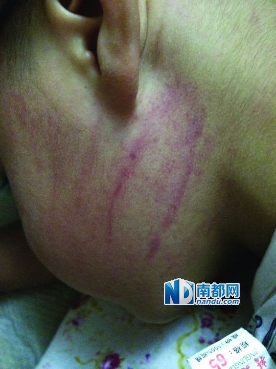 小逸臉上淤痕清晰可見。