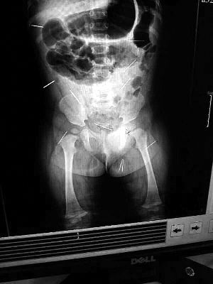 目前體內(nèi)的12根鋼針多分布在孩子的臀部，一根在腹部，其余3根在胸腔附近，其中一根很接近心臟