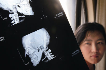 國內(nèi)醫(yī)院CT顯示，如今靳魏坤的鼻子假體是歪的，連下巴也是歪的