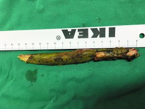 插入男子腦內(nèi)的樹(shù)枝。