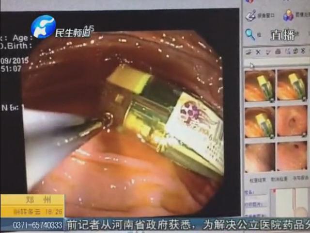 倆螺絲一個打火機(jī) 胃里發(fā)現(xiàn)的