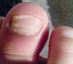 一幼兒園兒童“指甲異?！? title=